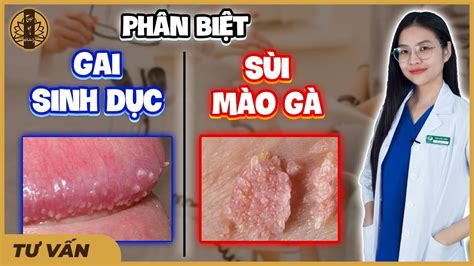 Gai sinh dục có ngứa không Nguyên nhân và cách điều trị hiệu quả