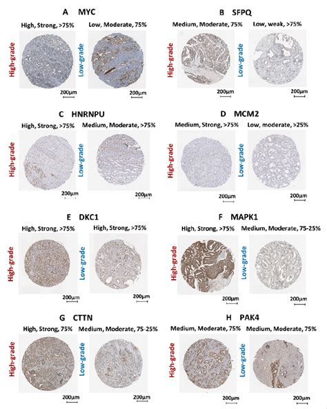 Validation Of Protein Expression Using Pca Clinical Tissue