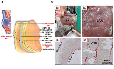 Frontiers Fatty Infiltration Of The Myocardium And Arrhythmogenesis