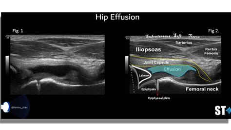 Hip Effusion – Sonographic Tendencies