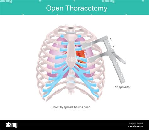 thoracotomy stock vector images alamy
