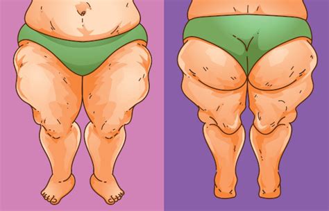 O Que Lipedema