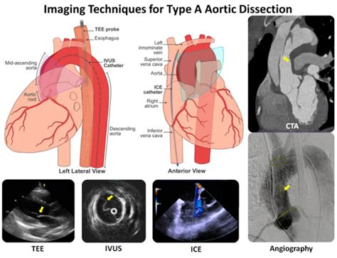 Imaging techniques for type A aortic dissection. Ultrasound-based... | Download Scientific Diagram