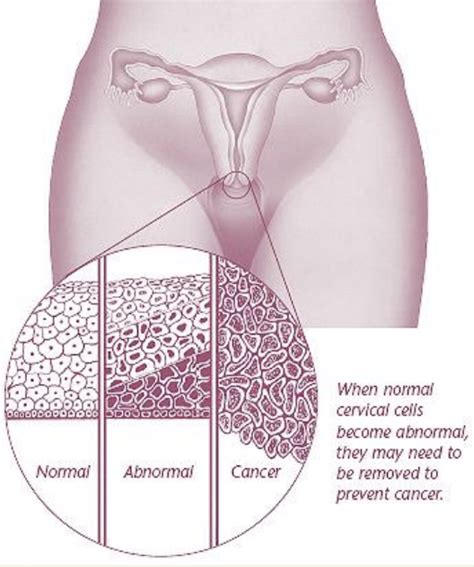 Leep Procedure For Cervical Cancer