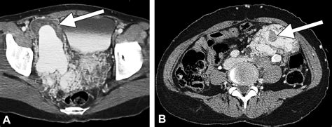 Arteriovenous Malformation Associated With Intravenous Leiomyomatosis