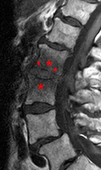 Discitis Radsource