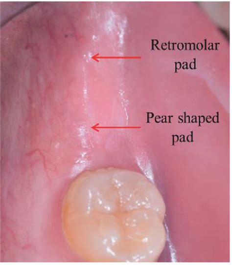 Retromolar Pad Anatomy