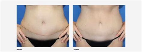 Scar Revision After Tummy Tuck