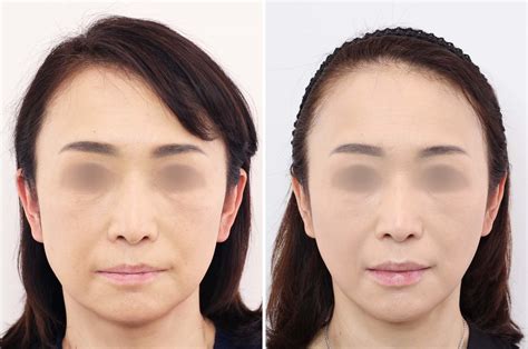 【50代でも】切らずにここまでリフトアップ！｜症例写真・ビフォーアフター｜美容整形･美容外科のtaクリニックグループ