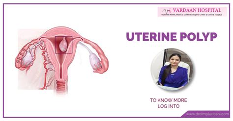 Uterine Polyps Types Symptoms Causes Treatment Diagnosis