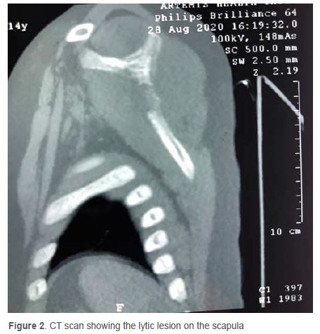 3D Printing In Osteosarcoma Of The Scapula A Unique Case