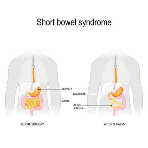 What Is Short Bowel Syndrome Everything You Need To Know Gi Associates