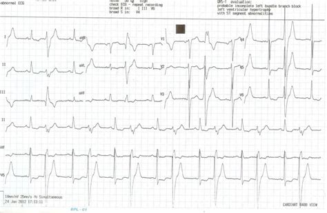 Ventricular Ectopic Beats And Mitral Regurgitation Drsvenkatesan Md