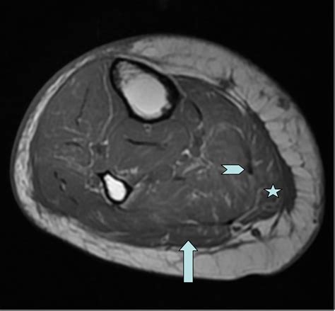 Plantaris Muscle Mri