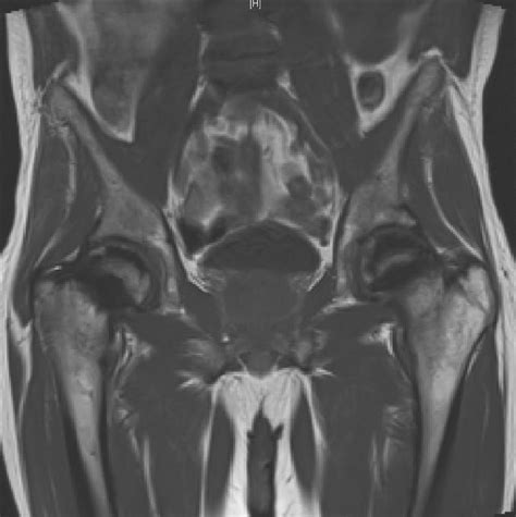 Magnetic Resonance Imaging Without Contrast Of The Pelvis Coronal