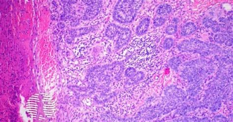 Pathology Of Basal Cell Carcinoma Image