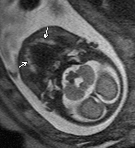 Mr Imaging Of The Fetal Face Comprehensive Review Radiographics