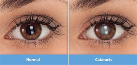 Discover Clear Vision Unveiling Common Symptoms Of Cataract