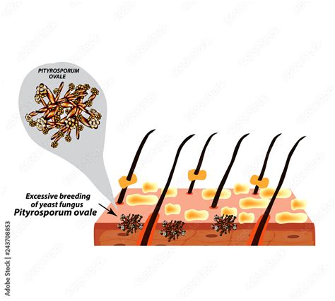 Fungal Yeast Pathogen Seborrhea Pityrosporum Ovale Malassezia Furfur