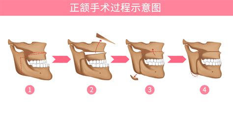 青岛市口腔医院：数字化3d打印技术辅助正颌手术 精准帮助患者改颜换貌 青岛新闻网