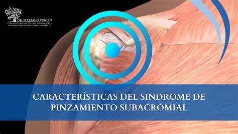 Caracter Sticas Del S Ndrome De Pinzamiento Subacromial Dr Mariano