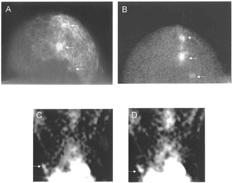 Figure 2 From Scintimammography With Dedicated Breast Camera In