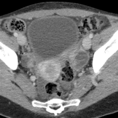 Contrast Enhanced Ct Scan Of The Pelvis Which Demonstrates Enhanced