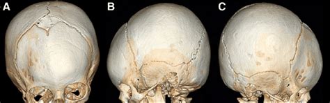 Three Dimensional Computed Tomographic Reconstruction At The Age Of 10 Download Scientific