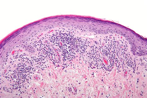 Histology Of Oral Lichen Planus