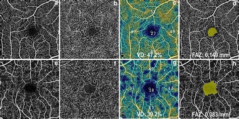 En Face Oct Angiograms Of The Mm Macular Region From A Healthy