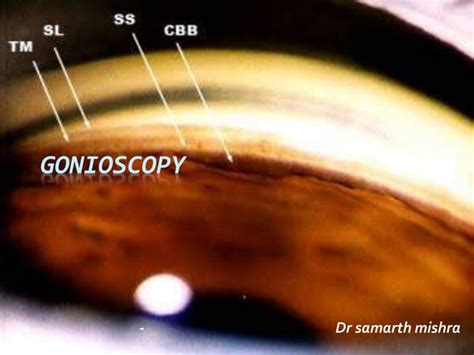 Gonioscopy Gonioscopic Lenses Principle And Clinical Aspects Ppt