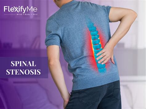 Spinal Stenosis Causes Symptoms Treatment Excercises