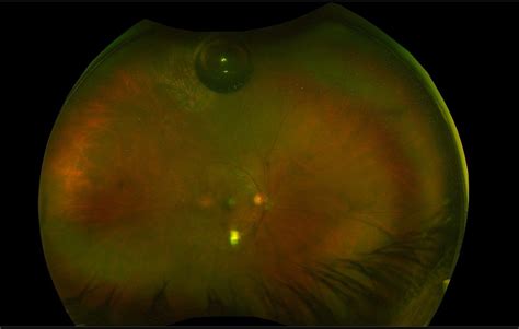 Intraocular Gases And Oil Macula Retina Vitreous Center