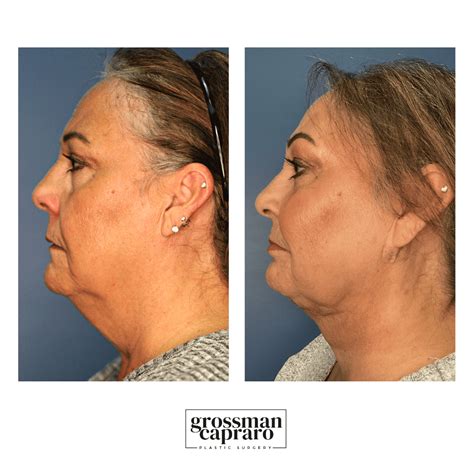 Face Renuvion Grossman Capraro Plastic Surgery