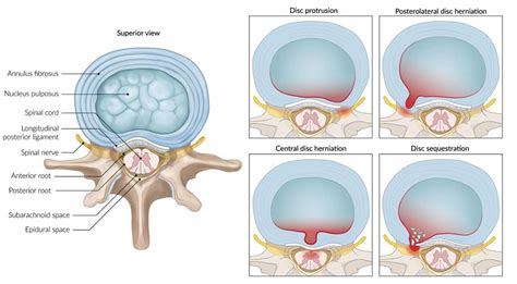 El N Cleo Interno N Cleo Pulposo Y Discos Espinales El Paso Tx