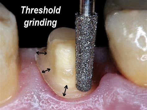 Fabrication Of A Dental Crown Ralev Dental Clinic