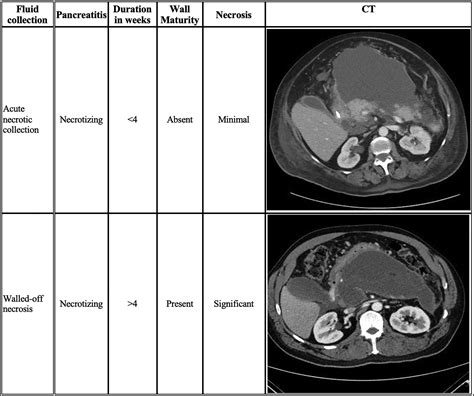 Endoscopic Ultrasound Guided Walled Off Necrosis Drainage Gastrointestinal Endoscopy Clinics