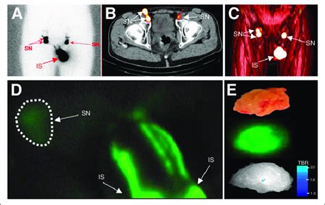 Sentinel Node Imaging A Standard Lymphography After Local