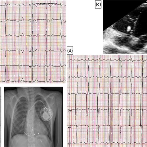 Case 2 Panel A 12‐lead Ecg Showing The Intrinsic Junctional Rhythm Download Scientific