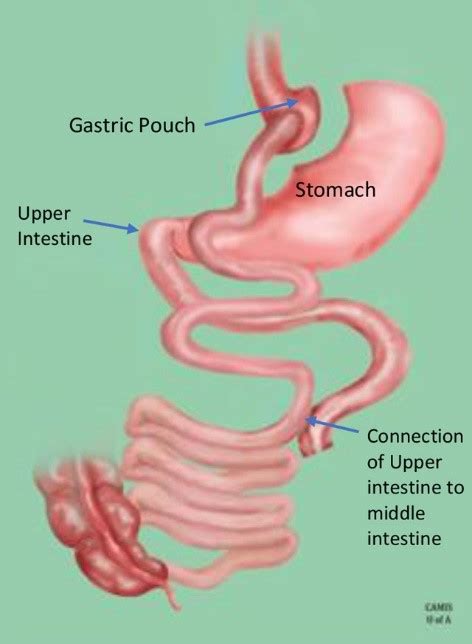 Bariatric Surgery Gastric Bypass