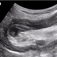 Ultrasonography Demonstrated An Ileoileal Intussusception With The