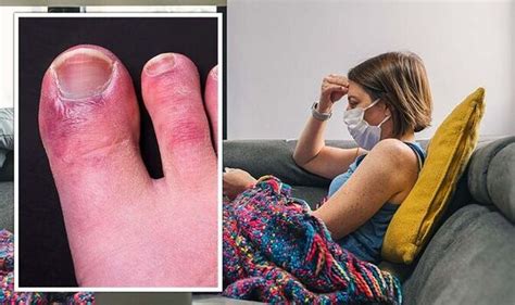 Covid symptoms include blistered feet and discoloured toes | Express.co.uk