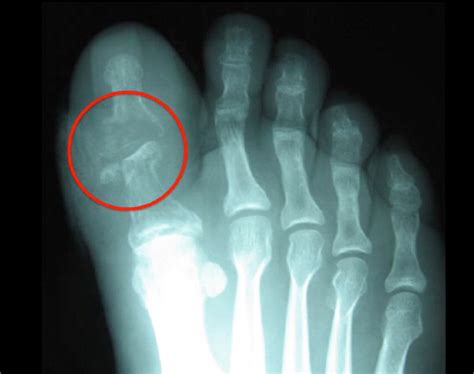 Osteomyelitis X Ray Foot