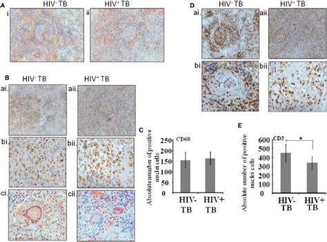 Cellular Architecture Of Spinal Tuberculosis Tb Granulomas [ A Download Scientific