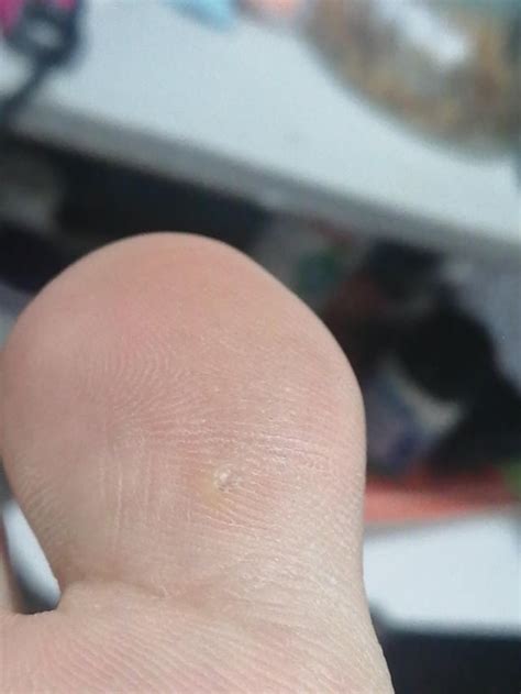 Is this a Splinter? : r/splinterremoval