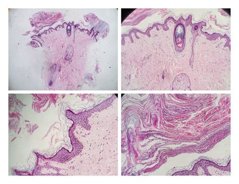 A Skin Biopsy Showing Marked Hyperkeratosis With Papillomatosis In The