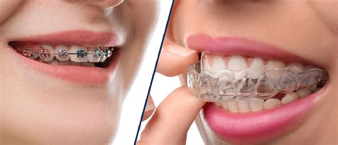 Invisalign Saiba Mais Sobre O Aparelho Transparente Inovador