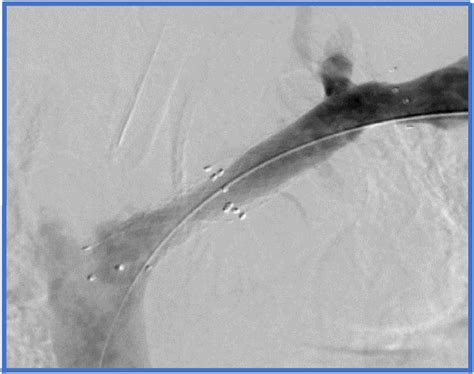 Final venogram showing a patent stent with no residual stenosis ...