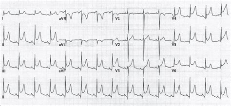 Dr Smiths Ecg Blog Why Is There St Depression In Avl In This Case Of Pericarditis