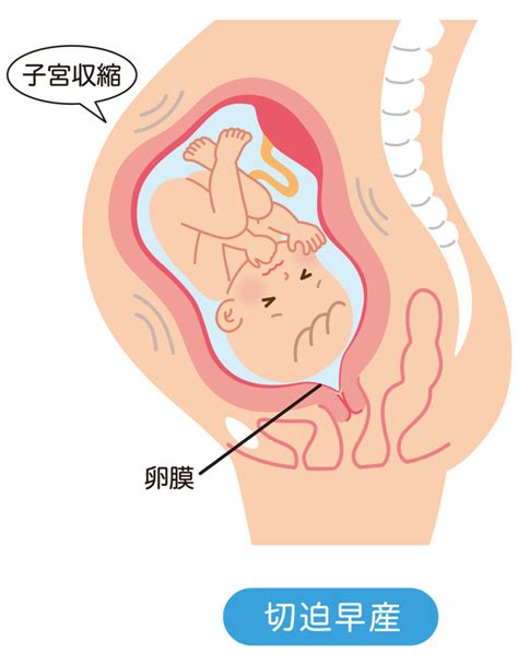 切迫早産の原因や特徴、診断は？過ごし方や予防のためのポイント ｜ 子育て応援サイト 教えてトイザらス・ベビーザらス